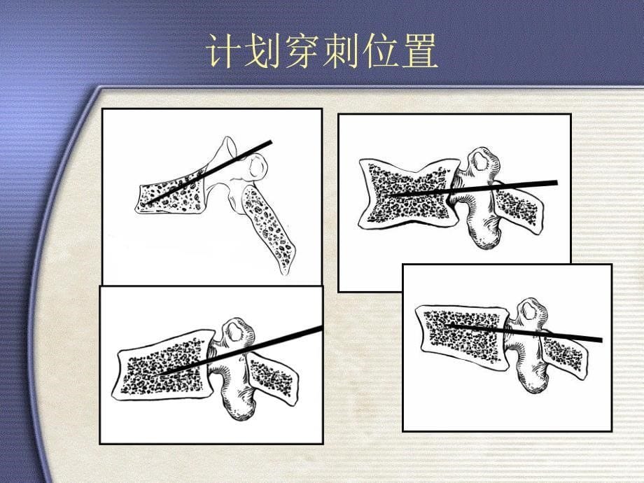 可膨胀球囊式 压迫性骨折椎体复位系统课件_第5页