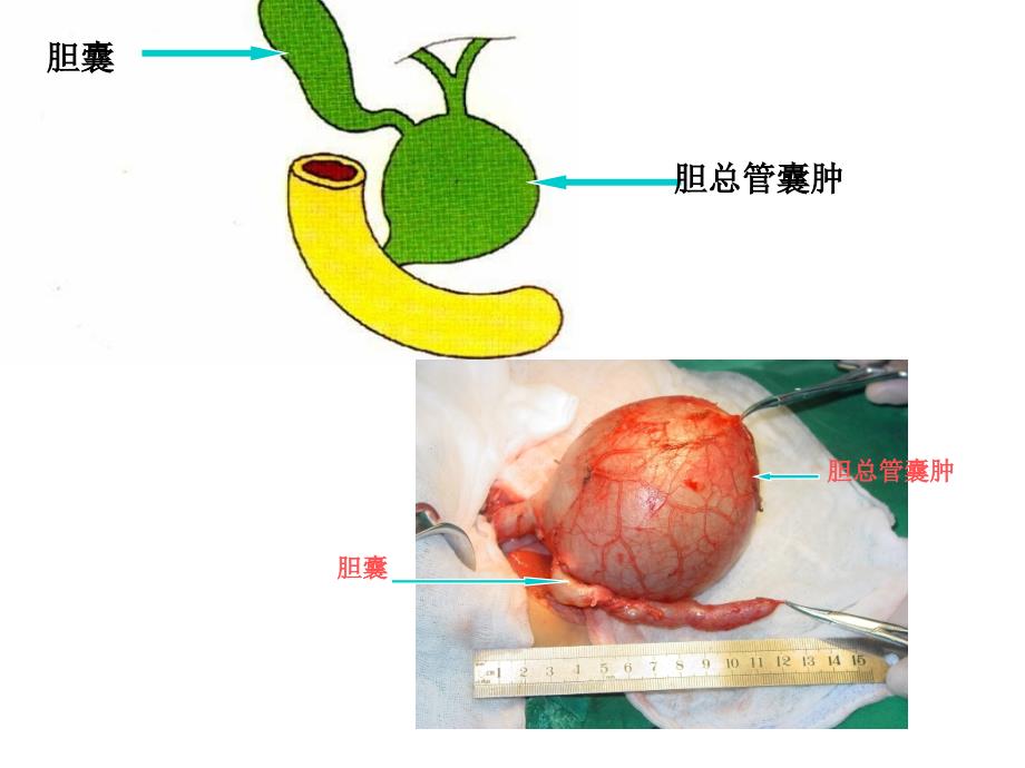 胆管扩张选修课（ppt）课件_第2页