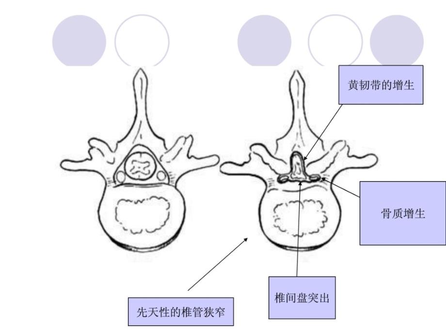 指南腰椎管狭窄症医学高级教导教导专区课件_第3页