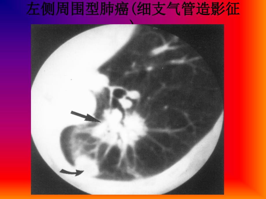 肺与纵隔影像诊断--第四、五节支气管与肺部疾病（三）_第2页