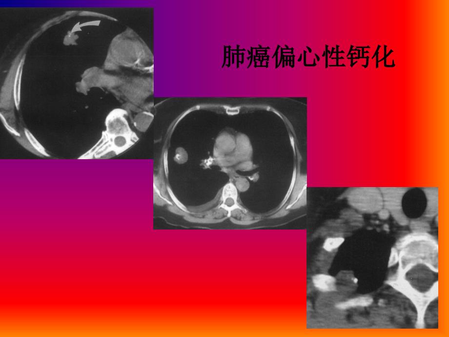 肺与纵隔影像诊断--第四、五节支气管与肺部疾病（三）_第4页