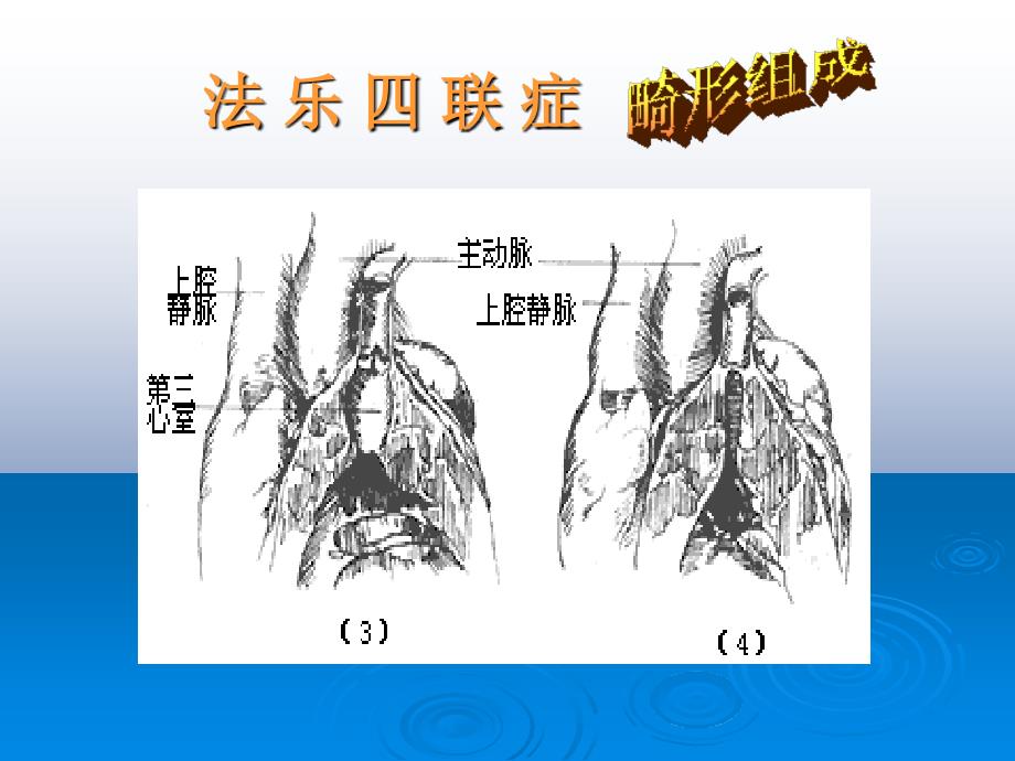 法乐四联症（医学病症基础学科课件）_第4页