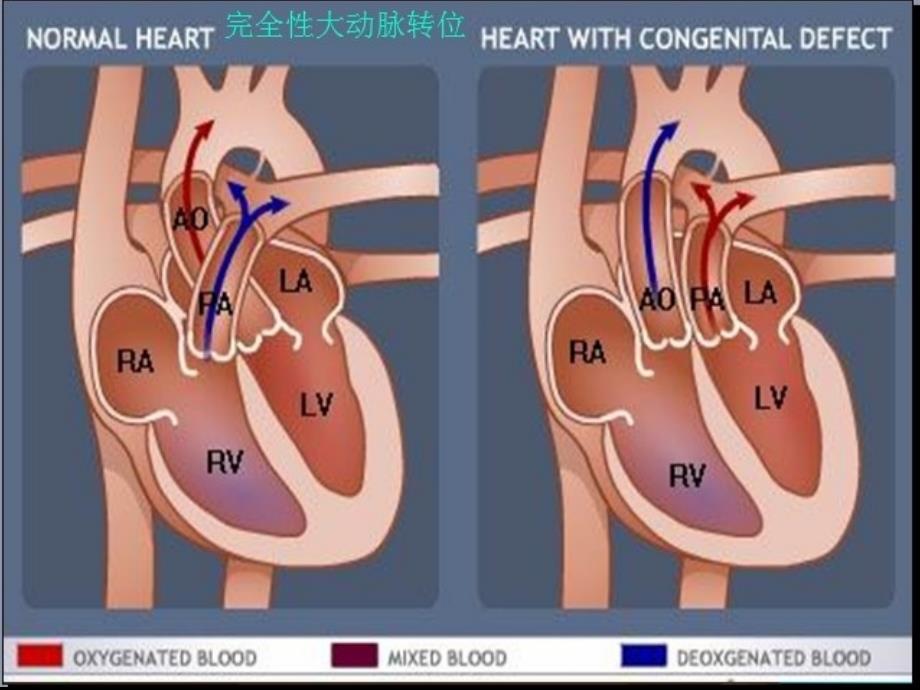 第二十讲大动脉转位课件_第3页