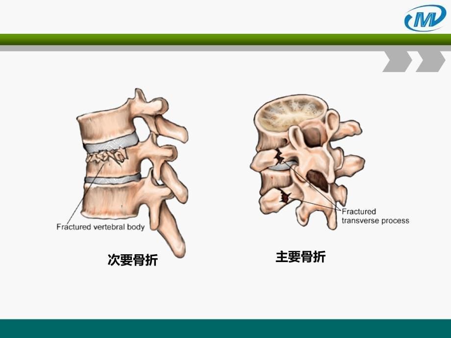 胸腰椎前路钉棒操作ppt课件_第5页