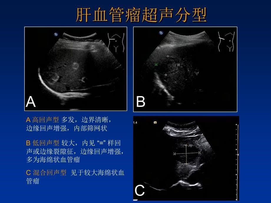 肝脏肿瘤超声诊断_第5页