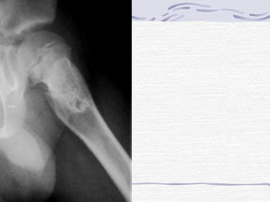 左股骨上端骨软骨瘤课件_第3页