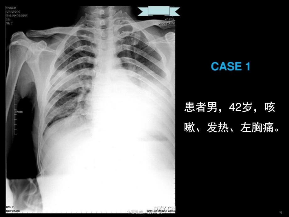 炎症结核肿瘤在ct及胸片上的差别图文最新课件_第4页