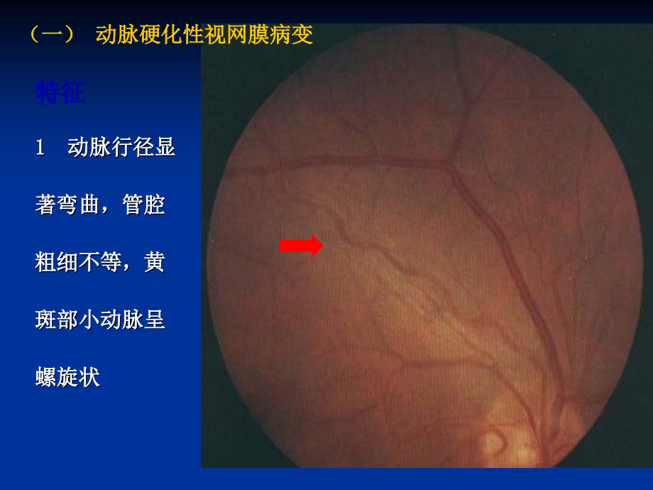 眼部常见提示疾病的表现ppt课件_第3页