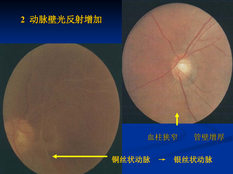 眼部常见提示疾病的表现ppt课件_第4页