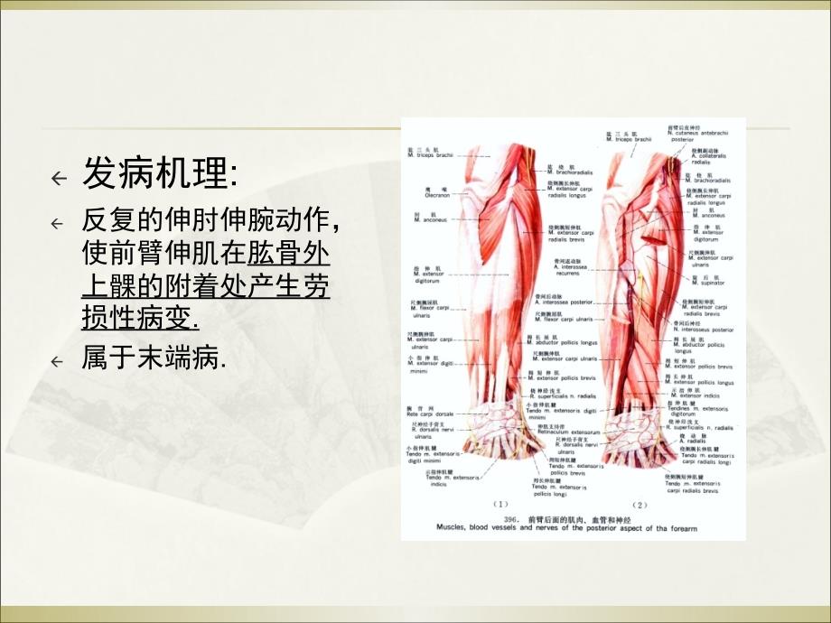 关节内型网球肘  针刀培训课件_第4页