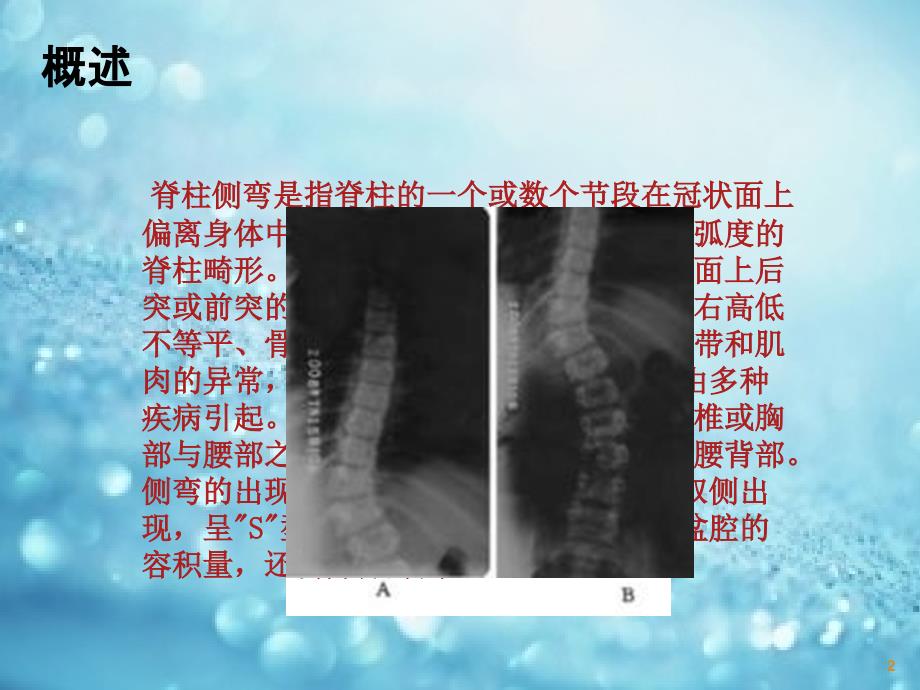 脊柱侧弯课件_2_第2页