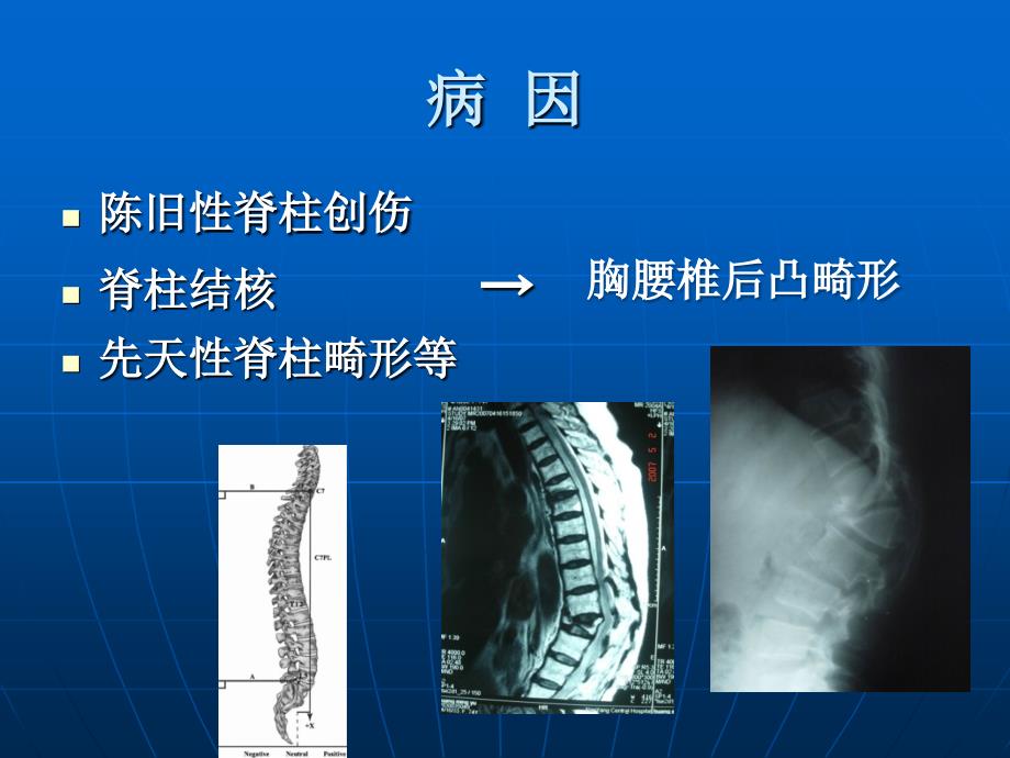 后路全脊椎截骨联合椎弓根钉棒固定术治疗胸腰椎脊柱后凸畸形课件_第2页