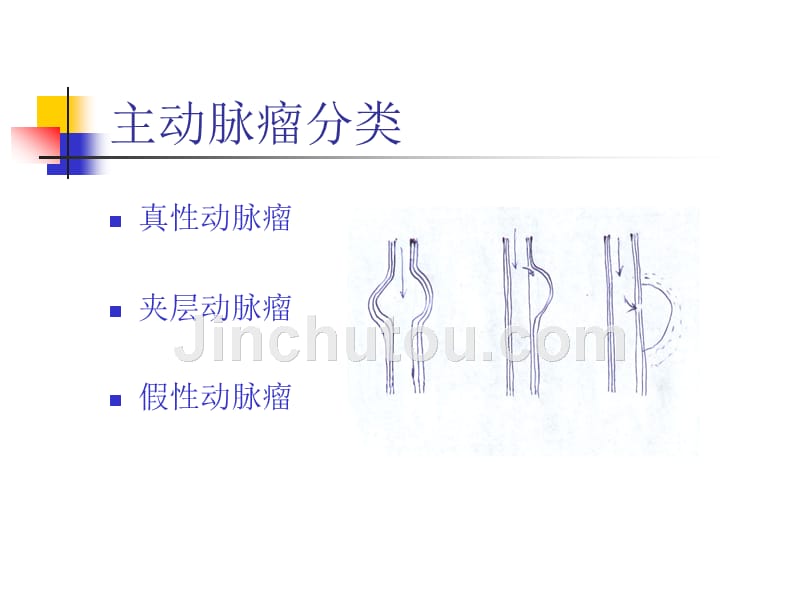 主动脉瘤常识课件_第4页