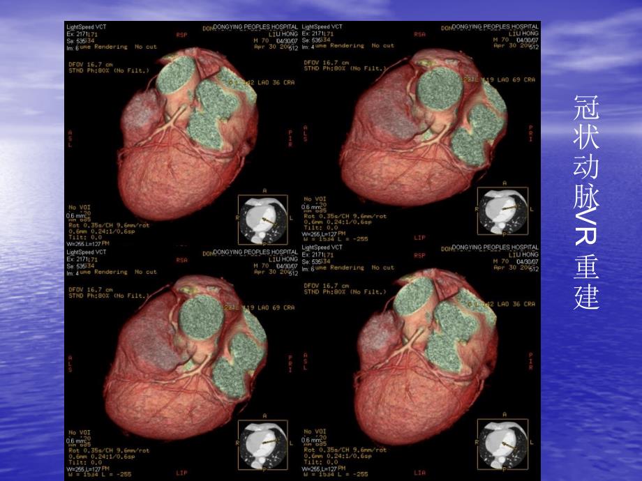 血管cta实践用课件_第3页