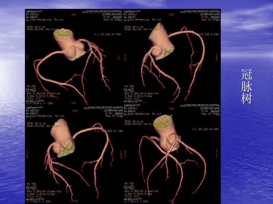 血管cta实践用课件_第5页
