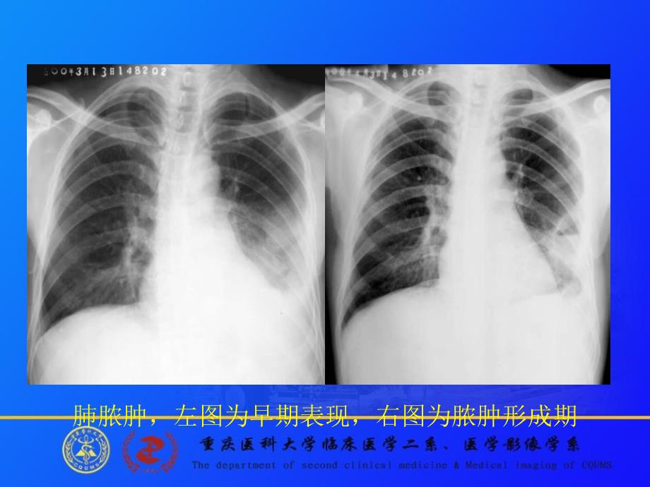 肺肿瘤的影像诊断 重庆医科大学第二医院放射诊断教研室 郭大静课件_1_第4页