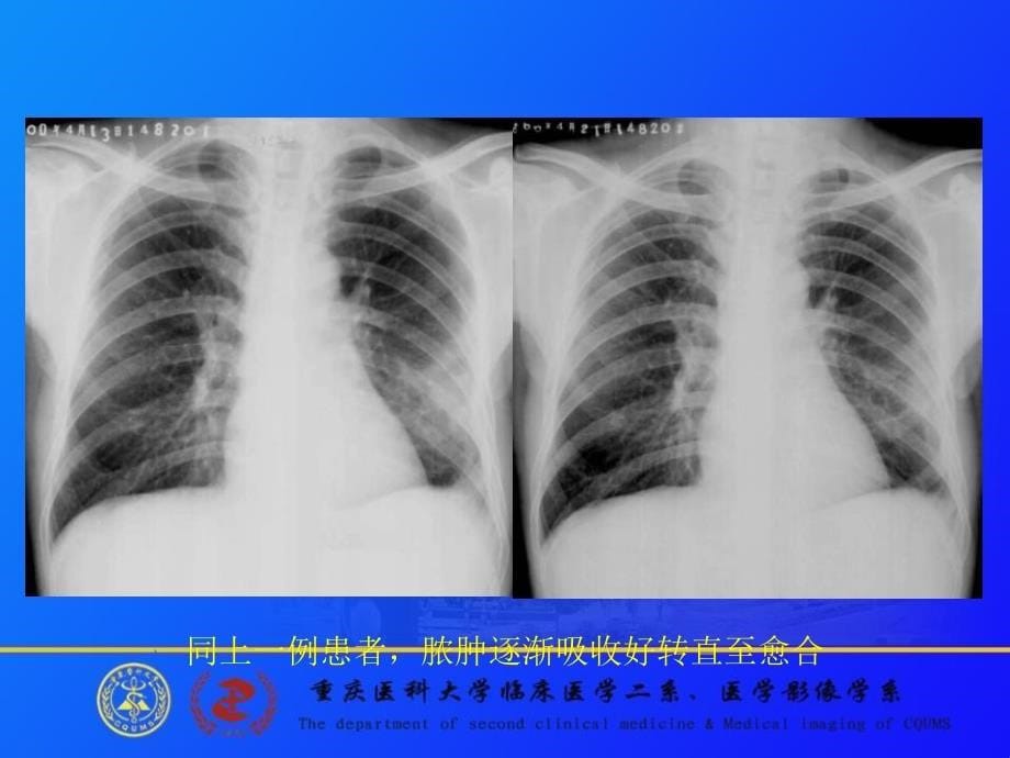 肺肿瘤的影像诊断 重庆医科大学第二医院放射诊断教研室 郭大静课件_1_第5页