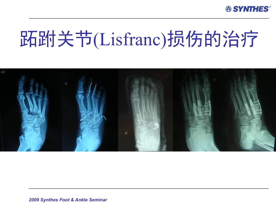 跖跗关节损伤synthesfoot ankleseminar ppt课件_第1页