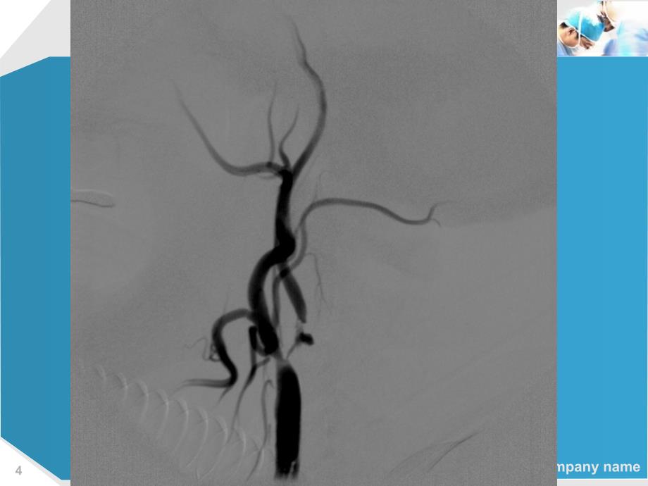 颈动脉狭窄合并基底尖动脉瘤血管内治疗课件_第4页