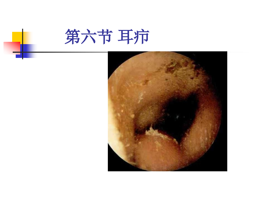 耳疖（第47页）课件_第1页