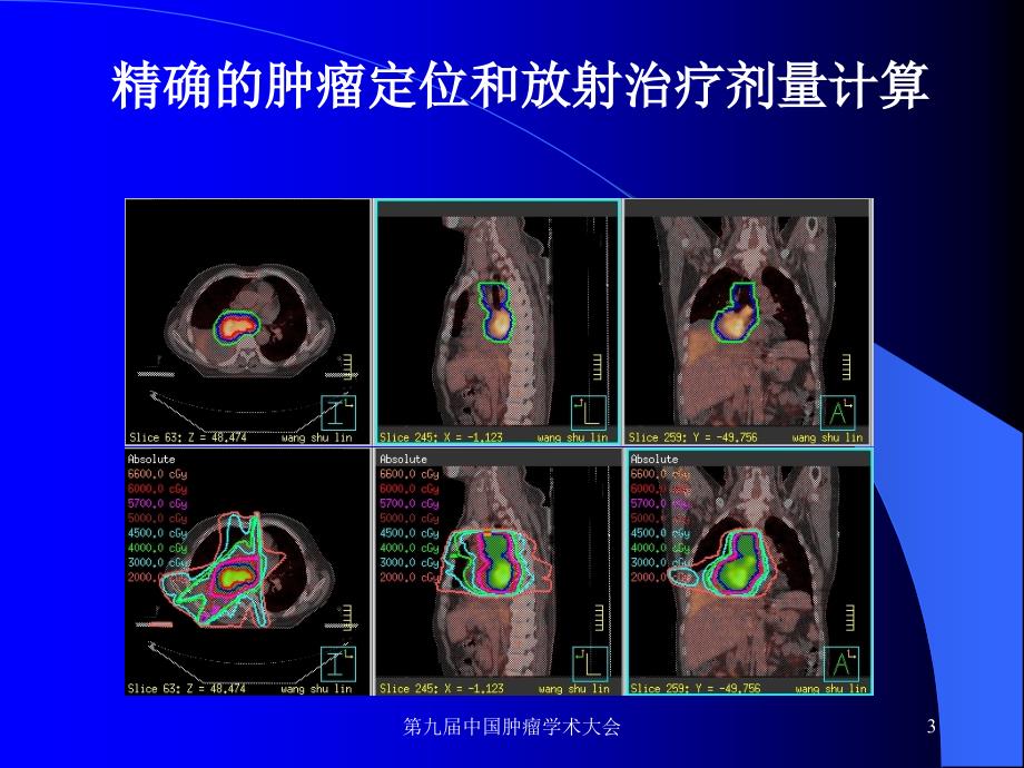 非小细胞肺癌的放射治疗精品课件_第3页