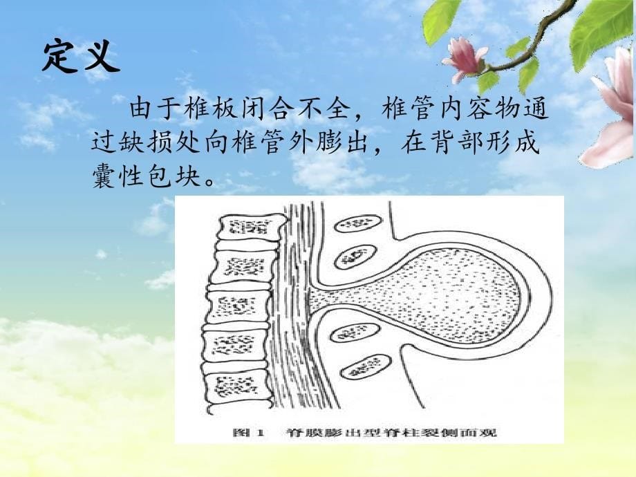 脊膜膨出 （1）课件_第5页