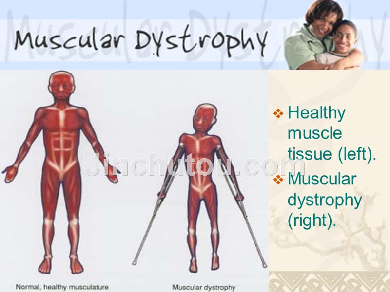 课件the molecular basis of muscular dystrophy（肌营养不良）_第5页