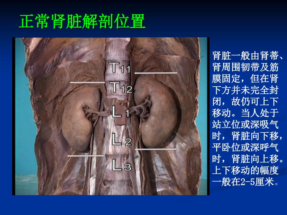 肾位置异常畸形课件_1_第3页