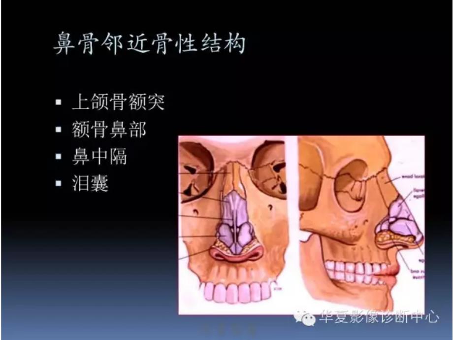 鼻骨骨折课件解析_第3页