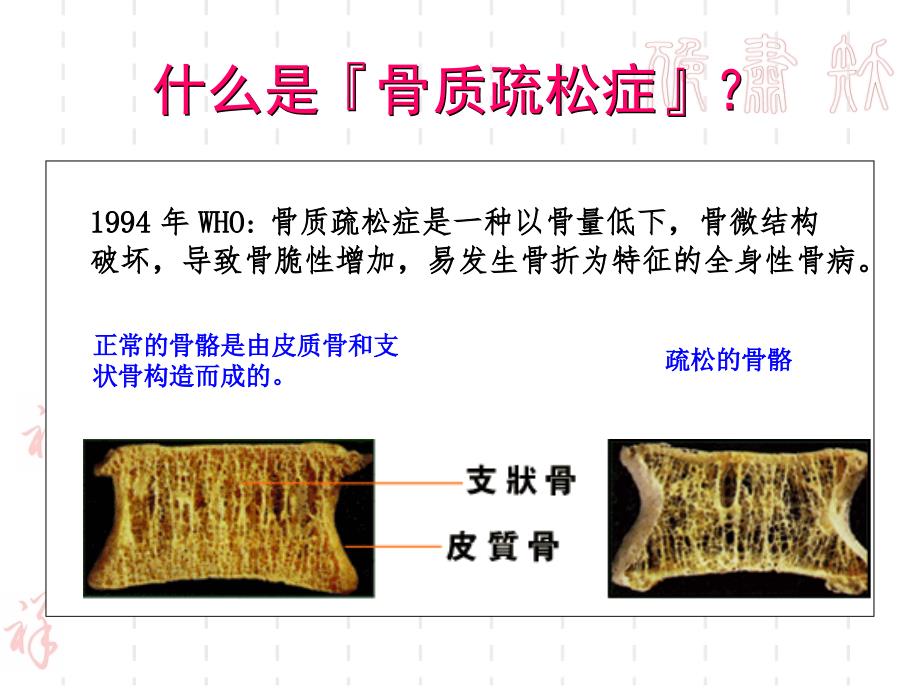 骨质疏松2课件_第2页