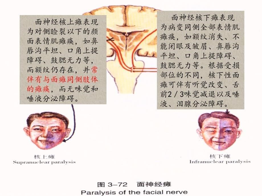 面神经炎面瘫的针灸康复治疗思路课件_第5页