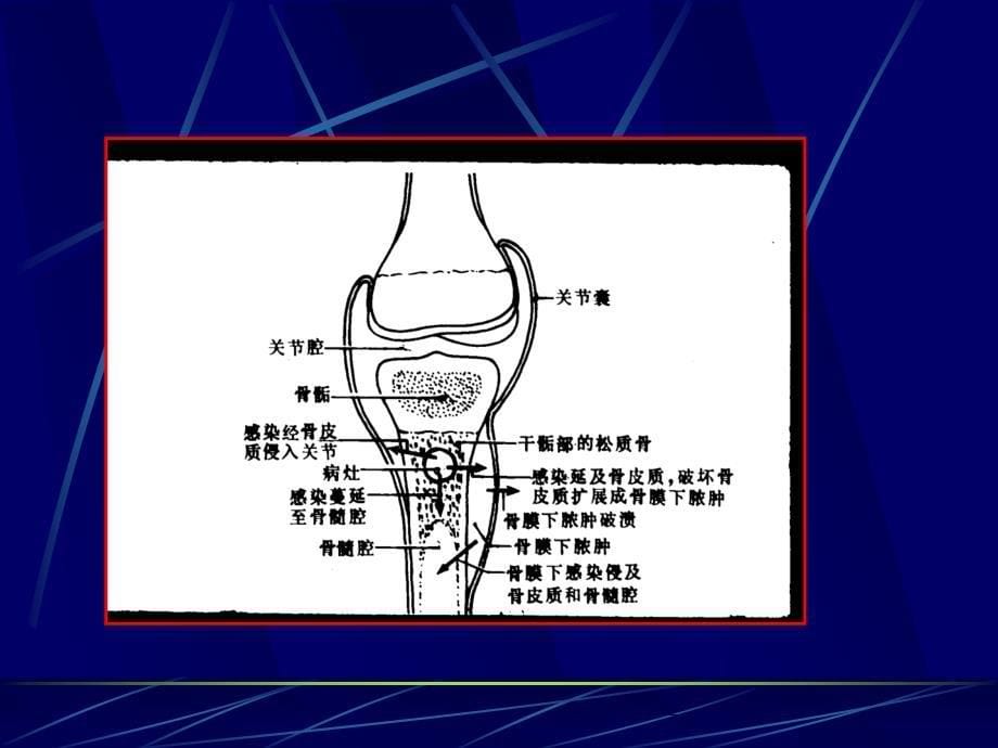 骨化脓性骨髓炎的影像学诊断精品课件_第5页