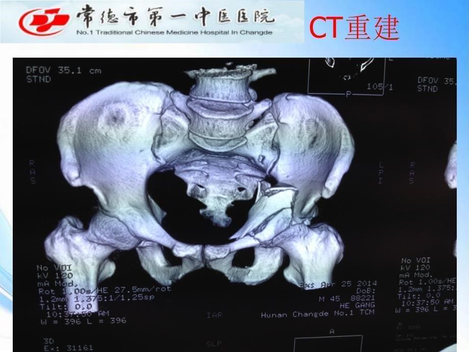 髋臼骨折王健课件_第5页