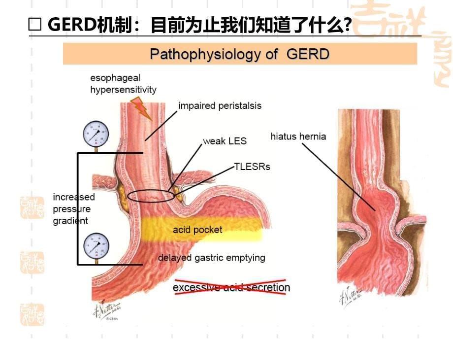 2013胃食管反流病 （学习）ppt课件_第5页