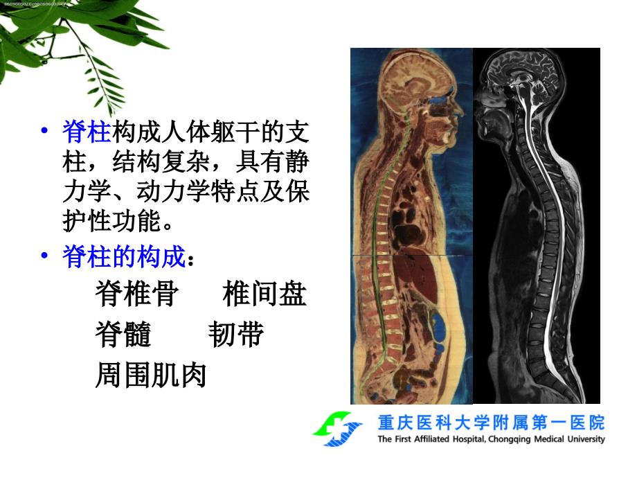 脊柱创伤的影像学诊断进展 ppt课件_第2页