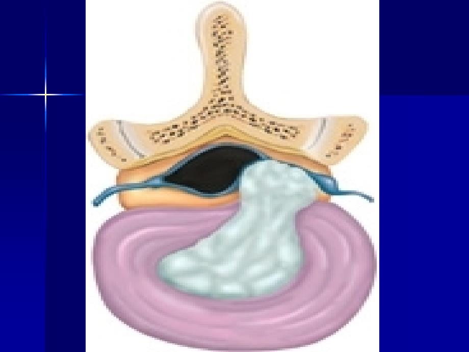 腰椎间盘突出症的微创治疗与护理措施ppt课件_第2页