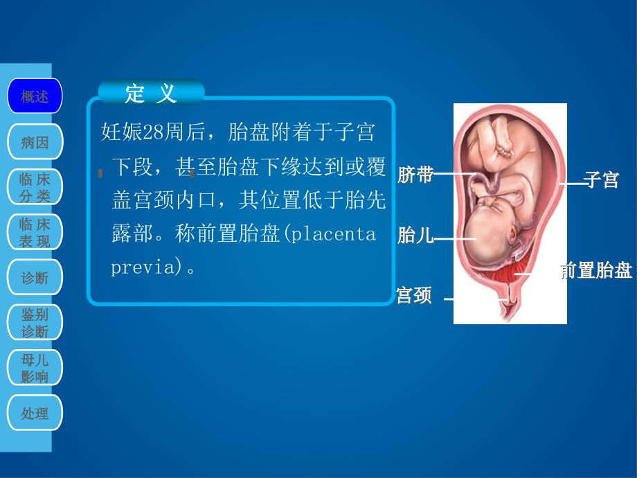 产科前置胎盘ppt课件_第4页