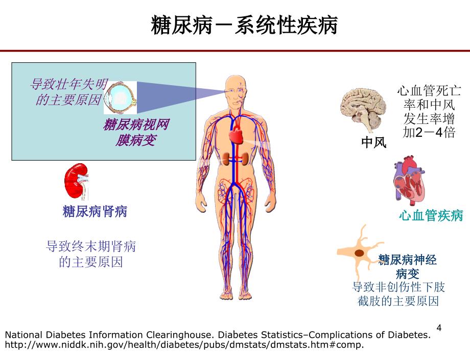 糖尿病视网膜病变ppt演示课件_第4页