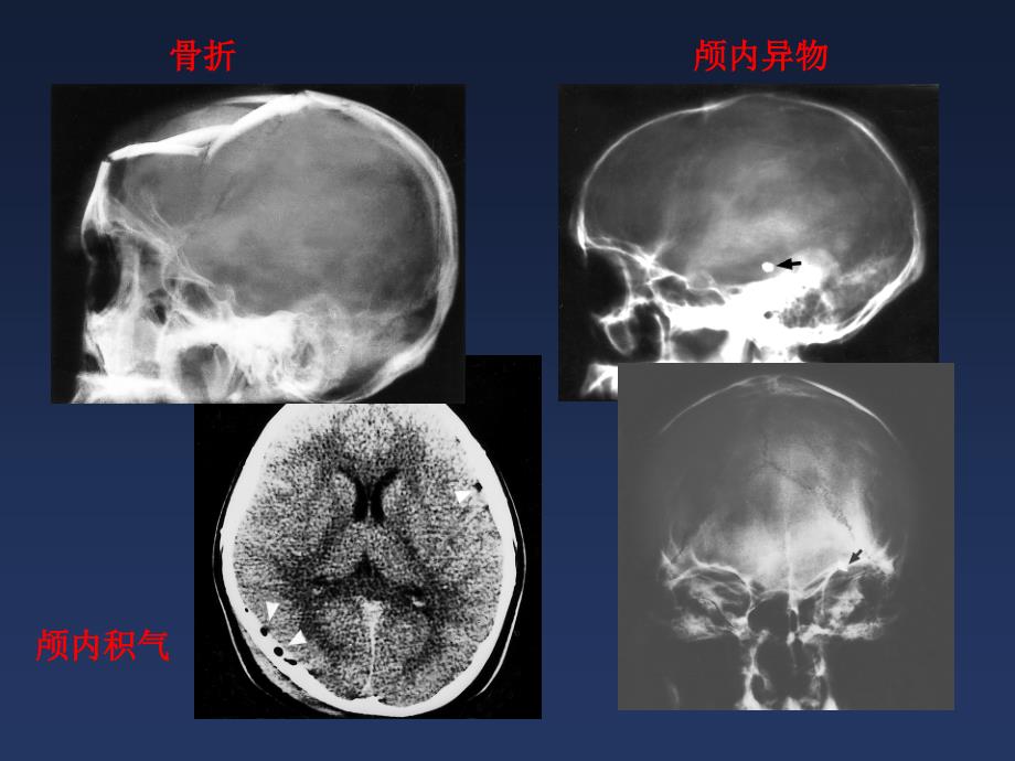 中枢神经系统4脑外伤课件_第2页