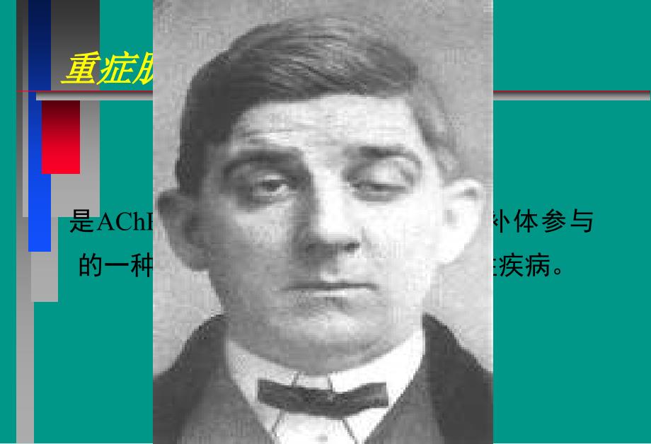 临床医学神经肌肉接头疾病课件_第4页