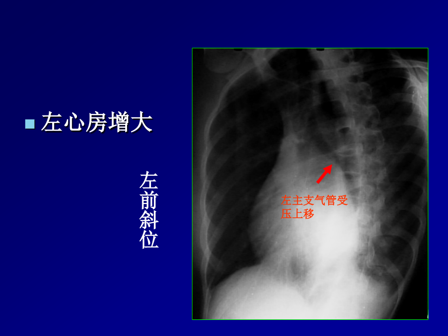 循环系统常见疾病x线表现课件_1_第4页