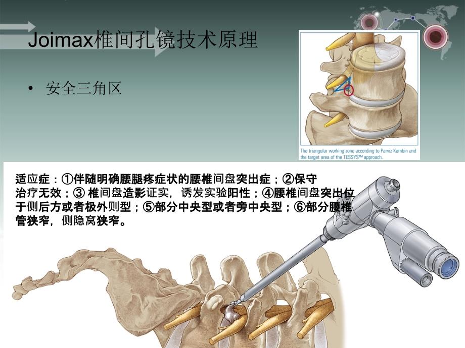 椎间孔镜手术护理配合ppt课件_第3页