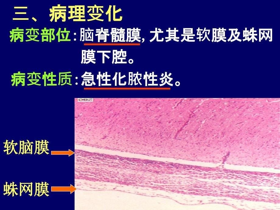 吴永廉《病理学》精品课件流行性脑脊髓膜炎_第5页