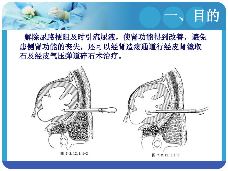 肾穿刺造瘘术的护理ppt课件_第3页