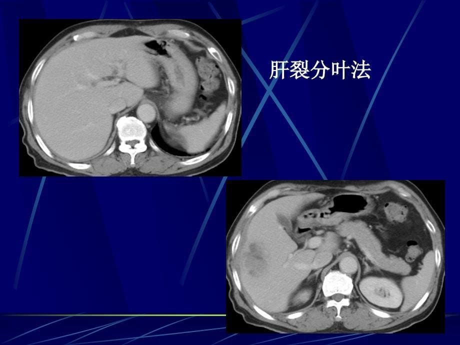 正常肝脏与疾病解剖对比ct详解课件_第5页