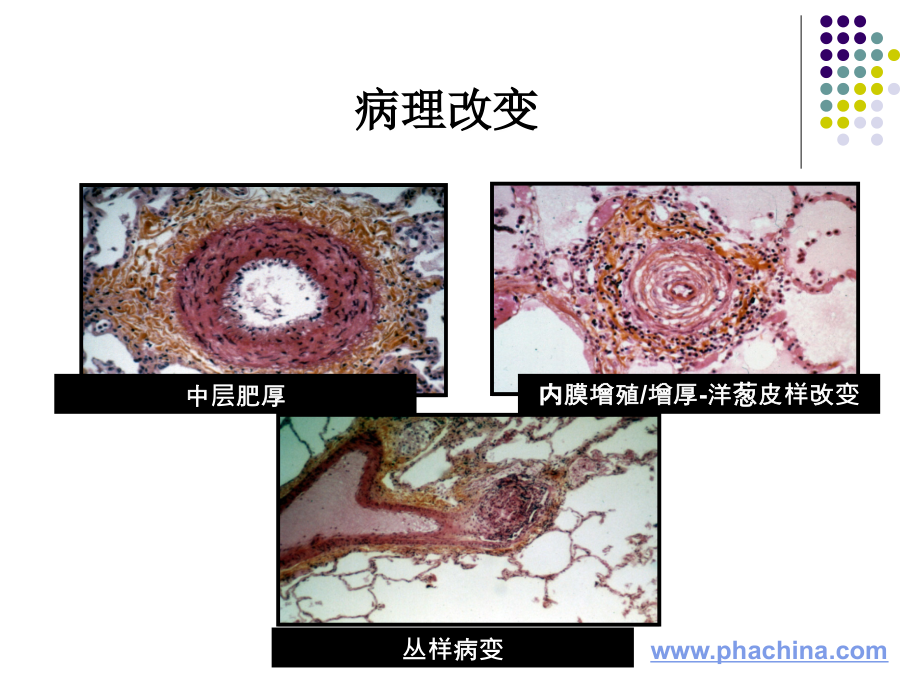 阜外教授肺动脉高压靶向药物治疗的研究进展资料课件_第4页