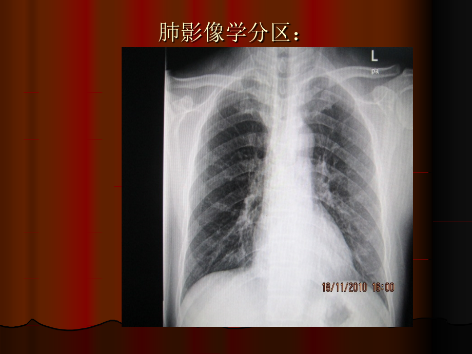 肺与胸膜病变的基本影像表现ppt课件_第4页