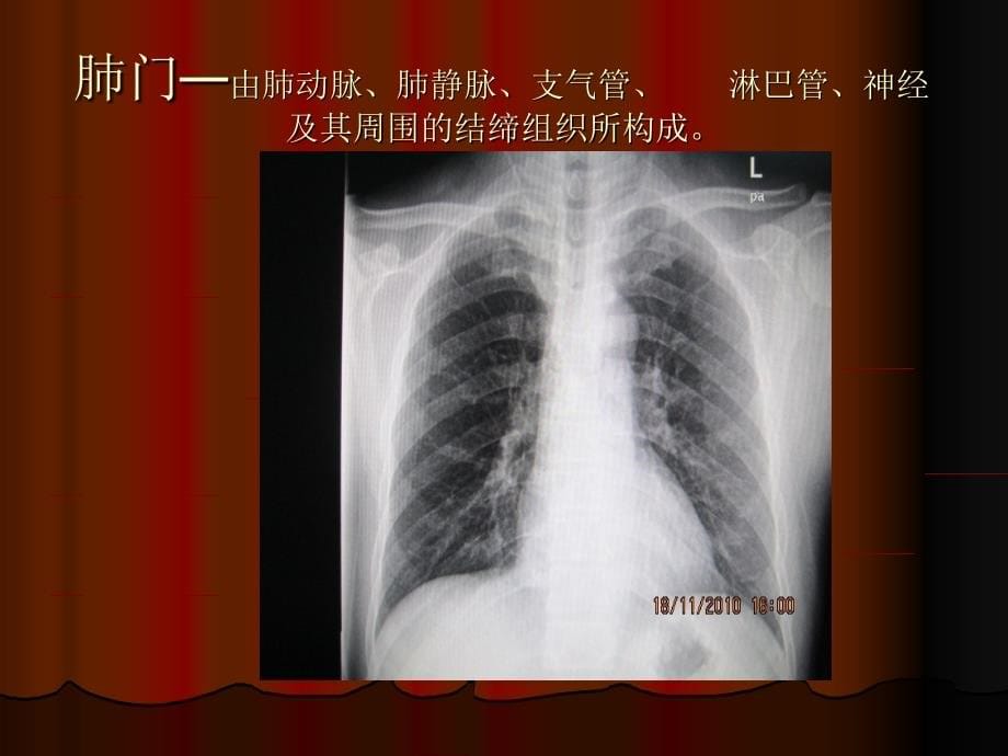肺与胸膜病变的基本影像表现ppt课件_第5页