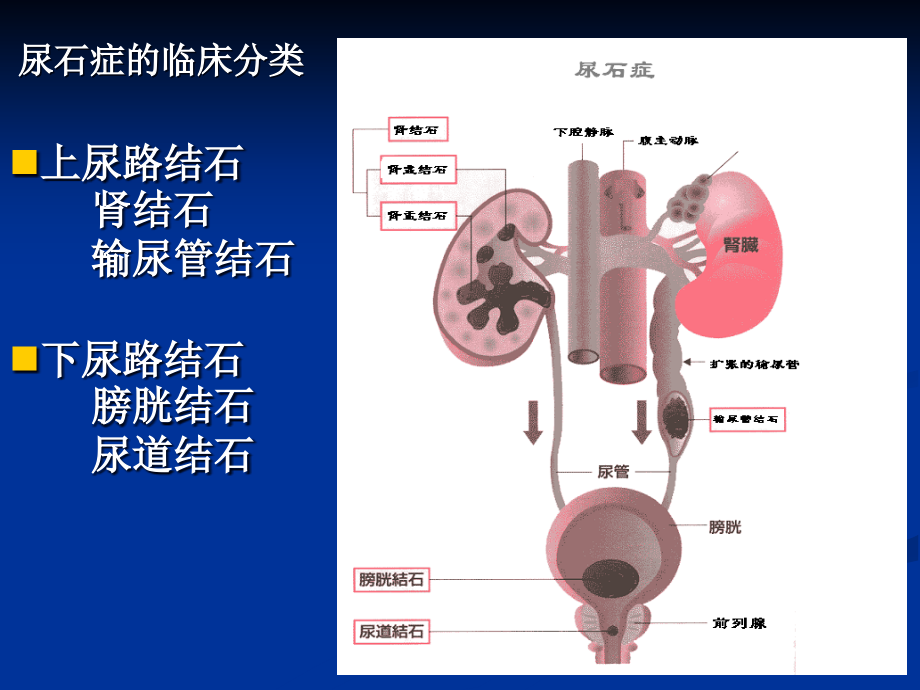 临床医学概论教学课件15尿石症_第4页