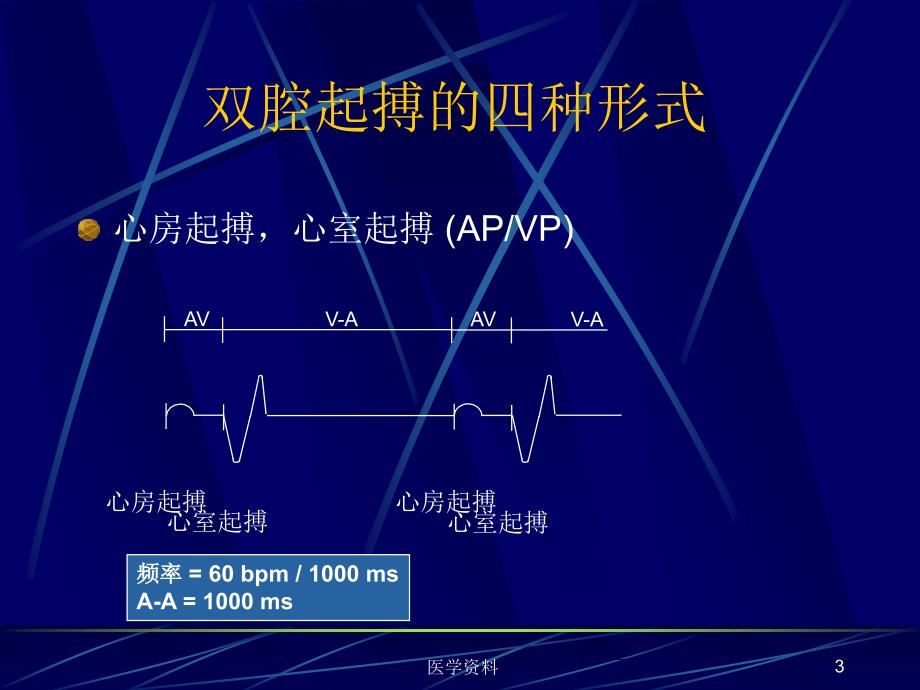 双腔起搏器技术及临床心电图表现  ppt课件_第3页